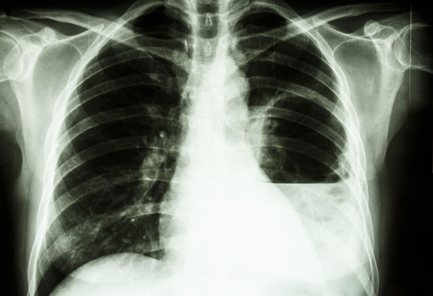 Penyakit paru-paru yang disebabkan oleh bakteri adalah