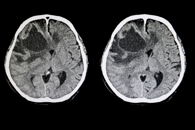 Gambar hitam putih hasil pemeriksaan otak untuk deteksi keberadaan tumor otak